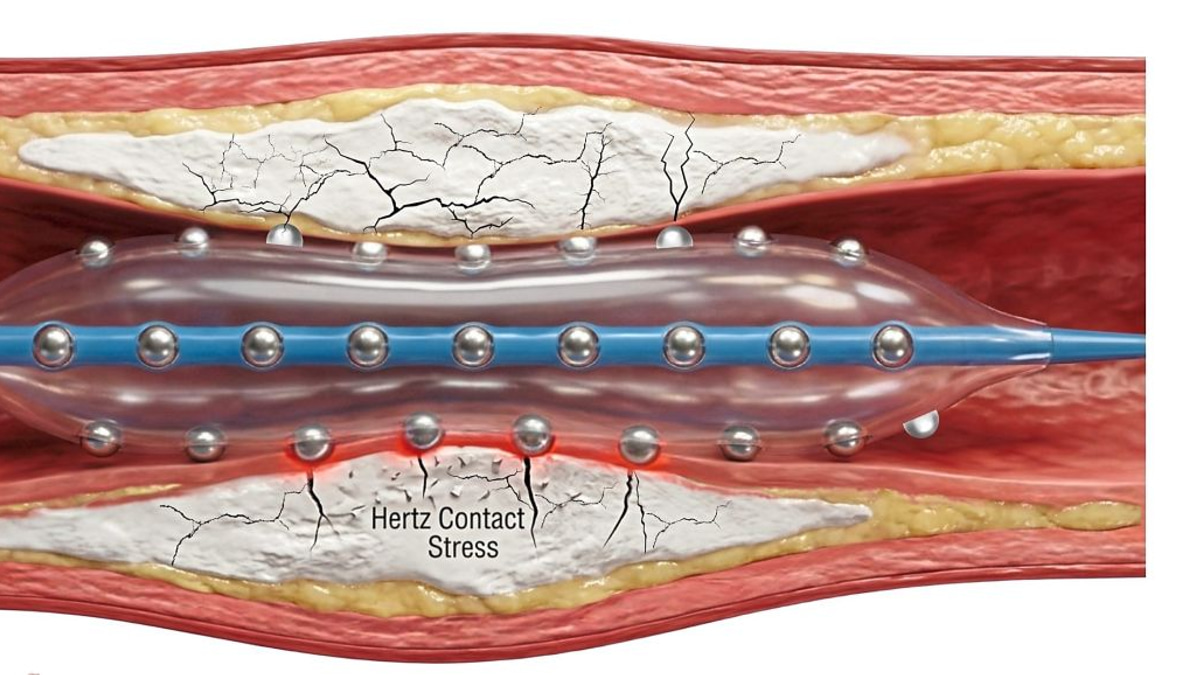 Malaysian cardiologists pioneer advanced treatment for severely calcified heart arteries