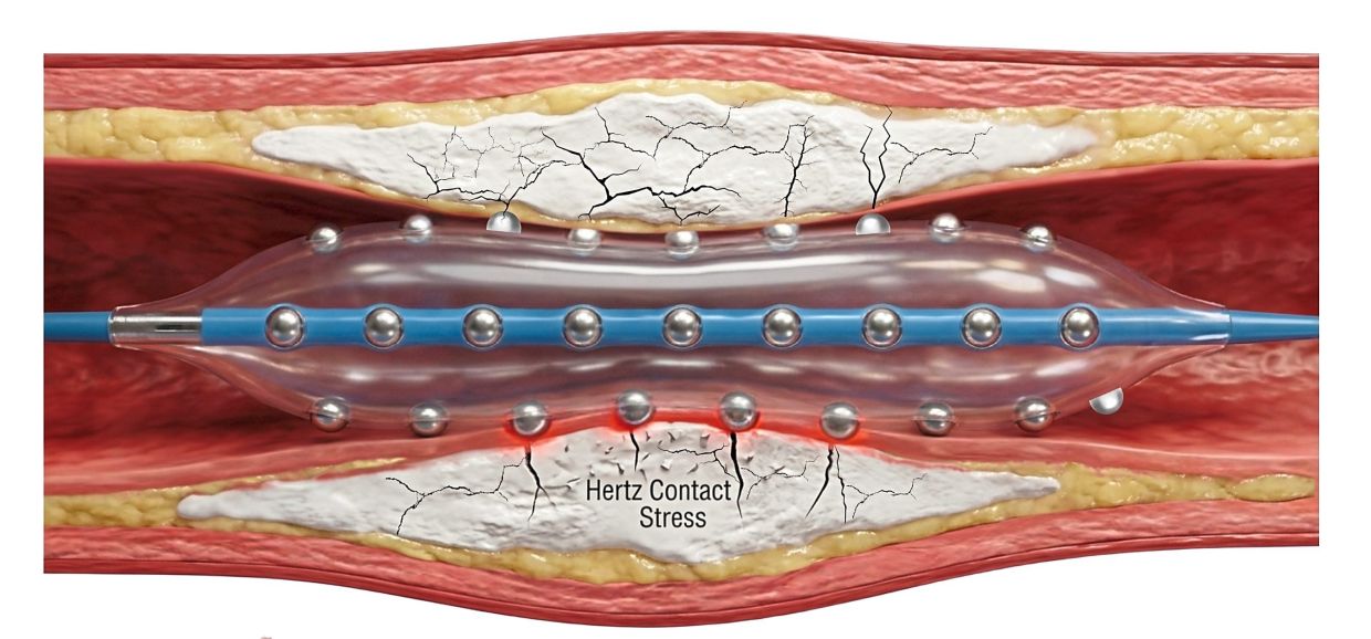 Malaysian cardiologists pioneer advanced treatment for severely calcified heart arteries